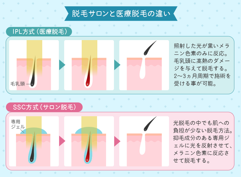 医学美容で使われる脱毛効果の顕著な長光波＆サロンのプロのIPL光技術 